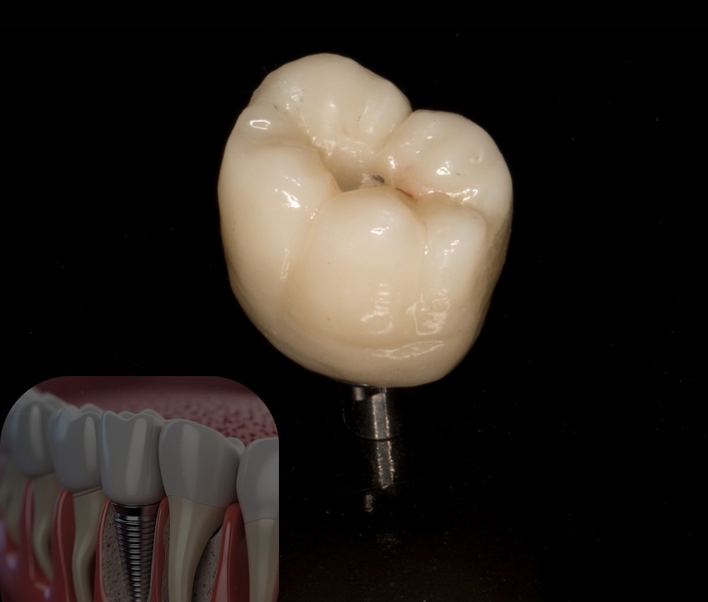 A ceramic crown attached to an implant post, with an inset illustration showing how an implant sits in the jaw